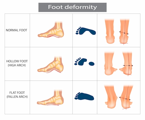 imagem mostrando anatomia da pisada
